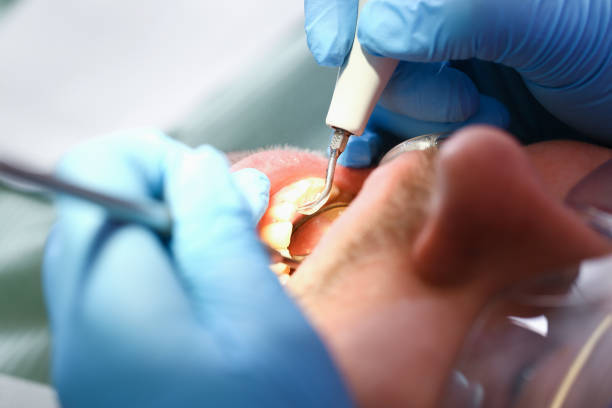 Best Dentist for Tooth Abscess  in Cottonwood, AL
