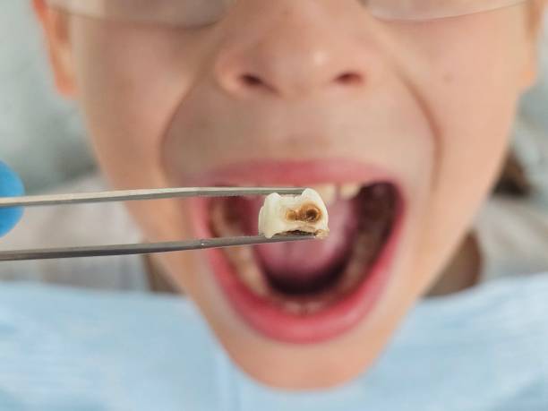 Best Knocked-Out Tooth Emergency  in Cottonwood, AL